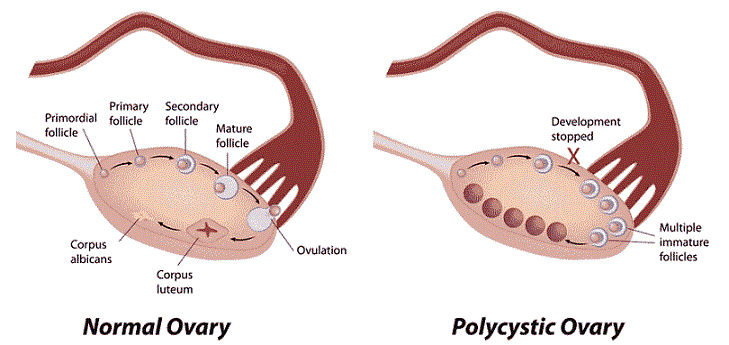 pcos-labeled